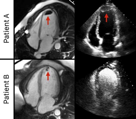 left ventricular thrombus after heart attack